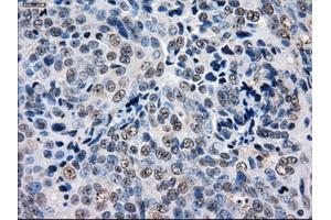 Immunohistochemical staining of paraffin-embedded Adenocarcinoma of ovary tissue using anti-GBE1 mouse monoclonal antibody. (GBE1 Antikörper)