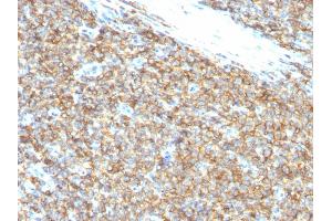 Formalin-fixed, paraffin-embedded human Ewing's Sarcoma stained with CD99 Monoclonal Antibody (12E7). (CD99 Antikörper)