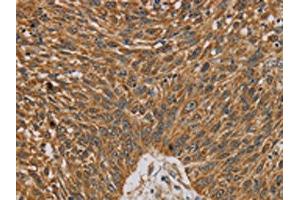 The image on the left is immunohistochemistry of paraffin-embedded Human lung cancer tissue using ABIN7130359(NDEL1 Antibody) at dilution 1/20, on the right is treated with fusion protein. (NDEL1 Antikörper)