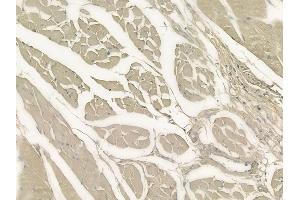 ABIN6264770 and ABIN6273310 at 1/100 staining human tongue carcinoma by IHC-P. (RLBP1 Antikörper  (Internal Region))