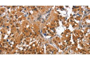 Immunohistochemistry of paraffin-embedded Human thyroid cancer tissue using CAMK1D Polyclonal Antibody at dilution 1:50 (CAMK1D Antikörper)