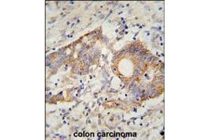 HHLA2 Antibody immunohistochemistry analysis in formalin fixed and paraffin embedded human colon carcinoma followed by peroxidase conjugation of the secondary antibody and DAB staining. (HHLA2 Antikörper  (N-Term))