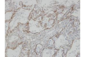 IHC-P Image Immunohistochemical analysis of paraffin-embedded human T(IV)(lung CA), using CLIC3, antibody at 1:100 dilution. (CLIC3 Antikörper)