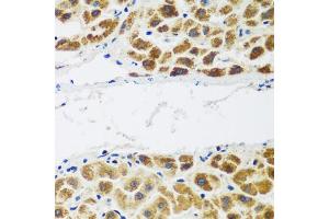 Immunohistochemistry of paraffin-embedded human liver cancer using NAA60 antibody. (NAT15 Antikörper)