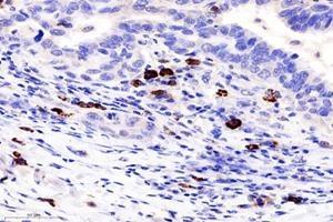 Immunohistochemistry analysis of paraffin-embedded human lung cancer using TCRb (ABIN7075813) at dilution of 1: 1800 (TCRb Antikörper)