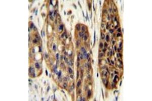 Immunohistochemistry analysis in formalin fixed and paraffin embedded human esophagus carcinoma reacted with KIAA1324L Antibody (N-term) followed which was peroxidase conjugated to the secondary antibody and ollowed by DAB staining. (KIAA1324-Like Antikörper  (N-Term))