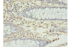Immunohistochemistry of paraffin-embedded human colon cancer using ABIN7166018 at dilution of 1:100 (RMND5B Antikörper  (AA 1-260))