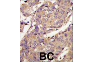 Formalin-fixed and paraffin-embedded breast carcinoma tissue reacted with UBE2L6 Antibody (C-term) (ABIN388854 and ABIN2839156) , which was peroxidase-conjugated to the secondary antibody, followed by DAB staining. (UBE2L6 Antikörper  (C-Term))