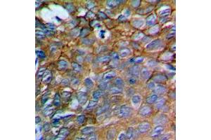 Immunohistochemical analysis of IL-12A staining in human prostate cancer formalin fixed paraffin embedded tissue section.