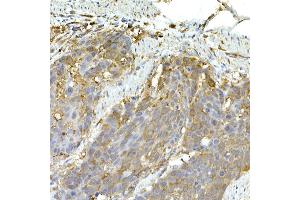 Immunohistochemistry of paraffin-embedded human esophageal cancer using IFIH1 Rabbit pAb (ABIN6131879, ABIN6142174, ABIN6142175 and ABIN6217724) at dilution of 1:50 (40x lens). (IFIH1 Antikörper  (AA 1-205))