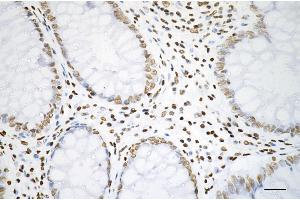 Immunohistochemistry was performed on paraffin-embedded human sigmoid colon carcinoma using histone H3 (acetyl K27) antibody (ABIN7798971), 1:200). (Rekombinanter Histone 3 Antikörper  (H3K27ac))