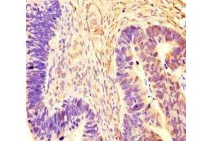 Immunohistochemistry of paraffin-embedded human ovarian cancer using ABIN7167721 at dilution of 1:100 (CoREST Antikörper  (AA 394-482))