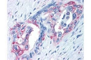 Anti-TRPM8 antibody IHC of human Pancreas, Carcinoma.