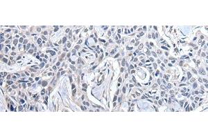 Immunohistochemistry of paraffin-embedded Human lung cancer tissue using PPIG Polyclonal Antibody at dilution of 1:50(x200)