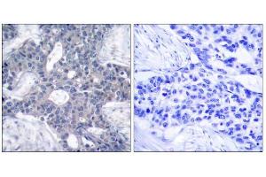 Immunohistochemical analysis of paraffin-embedded human breast carcinoma tissue, using Zap-70 (Ab-493) antibody (E021174). (ZAP70 Antikörper)