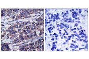 Immunohistochemical analysis of paraffin-embedded human breast carcinoma tissue, using p62Dok (phospho-Tyr362) antibody (E011276). (DOK1 Antikörper  (pTyr362))