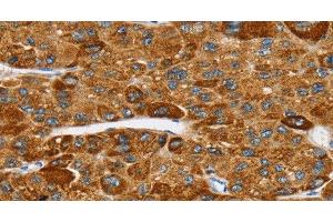 Immunohistochemistry of paraffin-embedded Human liver cancer tissue using SPARCL1 Polyclonal Antibody at dilution 1:30 (SPARCL1 Antikörper)