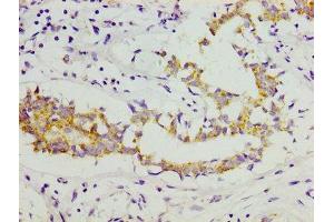 IHC image of ABIN7148223 diluted at 1:300 and staining in paraffin-embedded human breast cancer performed on a Leica BondTM system. (COL11A1 Antikörper  (AA 532-699))