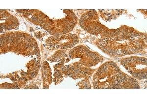 Immunohistochemistry of paraffin-embedded Human colon cancer tissue using ASCL1 Polyclonal Antibody at dilution 1:30 (ASCL1 Antikörper)