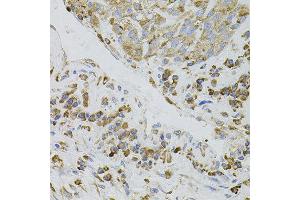 Immunohistochemistry of paraffin-embedded human lung cancer using IRF1 antibody.