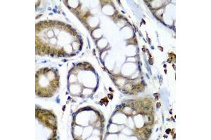 Immunohistochemistry of paraffin-embedded human colon carcinoma using SECISBP2 antibody (ABIN6128699, ABIN6147497, ABIN6147498 and ABIN6222461) at dilution of 1:200 (40x lens). (SECISBP2 Antikörper  (AA 585-854))