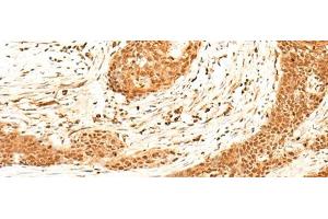 Immunohistochemistry of paraffin-embedded Human esophagus cancer tissue using HNF4A Polyclonal Antibody at dilution of 1:40(x200) (HNF4A Antikörper)