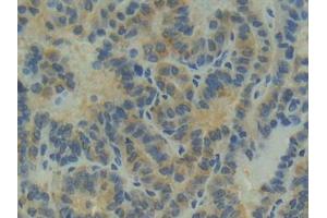 IHC-P analysis of Human Thyroid cancer Tissue, with DAB staining. (Apolipoprotein M Antikörper  (AA 8-188))