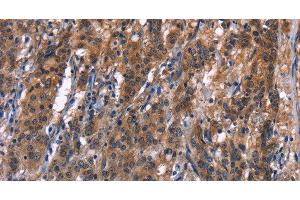 Immunohistochemistry of paraffin-embedded Human gastric cancer tissue using R3HCC1L Polyclonal Antibody at dilution 1:40 (GIDRP88 Antikörper)