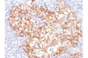 Formalin-fixed, paraffin-embedded human Renal Cell Carcinoma stained with CDH16-Monospecific Mouse Monoclonal Antibody (CDH16/2125).