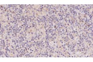 ABIN6273112 at 1/100 staining Human lymph cancer tissue by IHC-P. (DnaJ (Hsp40) Homolog, Subfamily B, Member 3 (DNAJB3) (Internal Region) Antikörper)