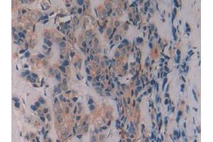 IHC-P analysis of Human Breast cancer Tissue, with DAB staining. (Caveolin-1 Antikörper  (AA 2-104))
