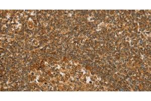 Immunohistochemistry of paraffin-embedded Human tonsil tissue using SLC6A3 Polyclonal Antibody at dilution 1:50 (SLC6A3 Antikörper)