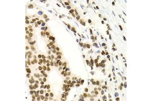 Immunohistochemistry of paraffin-embedded human breast cancer using NFKB2 Antibody (ABIN1873900) at dilution of 1:100 (40x lens). (NFKB2 Antikörper)