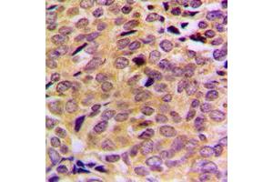 Immunohistochemical analysis of MRPL21 staining in human breast cancer formalin fixed paraffin embedded tissue section. (MRPL21 Antikörper  (Center))
