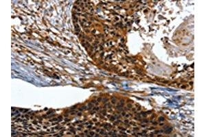The image on the left is immunohistochemistry of paraffin-embedded Human esophagus cancer tissue using ABIN7131518(TWF1 Antibody) at dilution 1/30, on the right is treated with fusion protein. (TWF1 Antikörper)
