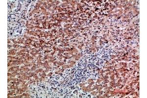 Immunohistochemical analysis of paraffin-embedded human-liver-cancer, antibody was diluted at 1:200. (GDF2 Antikörper  (AA 371-420))