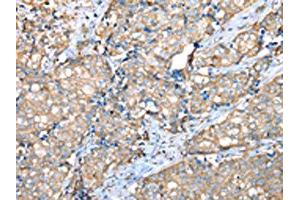 The image on the left is immunohistochemistry of paraffin-embedded Human breast cancer tissue using ABIN7128073(VAPA Antibody) at dilution 1/30, on the right is treated with fusion protein. (VAPA Antikörper)