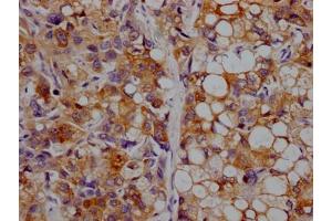 IHC image of ABIN7127343 diluted at 1:100 and staining in paraffin-embedded human liver cancer performed on a Leica BondTM system. (Rekombinanter APOC3 Antikörper)