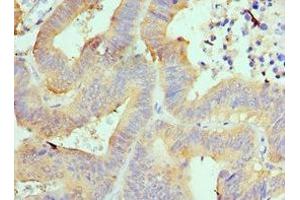 Immunohistochemistry of paraffin-embedded human colon cancer using ABIN7143994 at dilution of 1:100 (AIMP1 Antikörper  (AA 25-180))