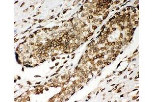 IHC-P: Lamin A antibody testing of human breast cancer tissue (Lamin A/C Antikörper  (AA 481-646))