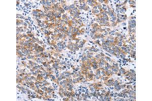 Immunohistochemistry of Human breast cancer using CLDN3 Polyclonal Antibody at dilution of 1:25 (Claudin 3 Antikörper)