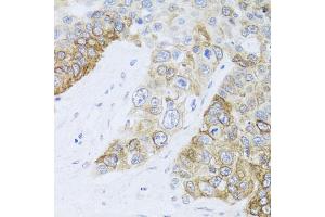 Immunohistochemistry of paraffin-embedded human lung cancer using CHD1 antibody.
