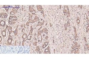 Immunohistochemistry of paraffin-embedded Human liver cancer tissue using CD5 Monoclonal Antibody at dilution of 1:200. (CD5 Antikörper)