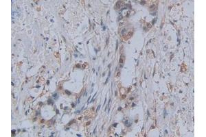 DAB staining on IHC-P; Samples: Human Pancreatic cancer Tissue (CCL2 Antikörper  (AA 24-99))