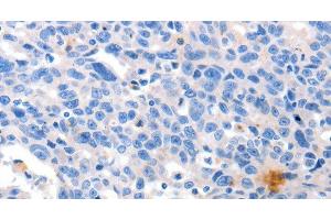 Immunohistochemistry of paraffin-embedded Human ovarian cancer tissue using GRIN2D Polyclonal Antibody at dilution 1:30 (GRIN2D Antikörper)