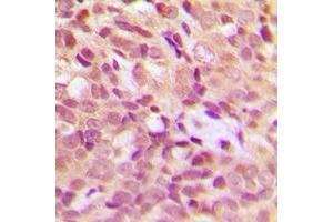 Immunohistochemical analysis of HSP27 (pS15) staining in human breast cancer formalin fixed paraffin embedded tissue section.