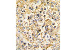 Formalin-fixed and raffin-embedded human breast carcinoma tissue reacted with Natriuretic Peptide Receptor A (NPR1/AN) antibody (N-term) (ABIN392702 and ABIN2842183) , which was peroxidase-conjugated to the secondary antibody, followed by DAB staining. (NPR1 Antikörper  (N-Term))