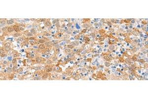 Immunohistochemistry of paraffin-embedded Human cervical cancer tissue using FANCB Polyclonal Antibody at dilution of 1:60(x200) (FANCB Antikörper)