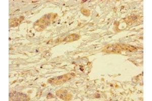 Immunohistochemistry of paraffin-embedded human pancreatic cancer using ABIN7166350 at dilution of 1:100 (YIPF6 Antikörper  (AA 2-84))