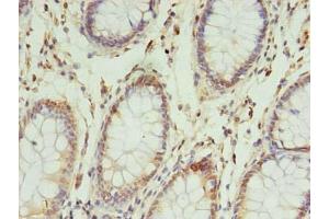 Immunohistochemistry of paraffin-embedded human colon cancer using ABIN7142648 at dilution of 1:100 (NSUN4 Antikörper  (AA 26-284))